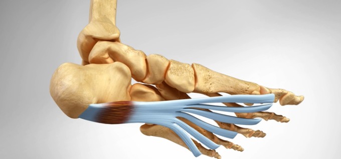 fascitis-plantar